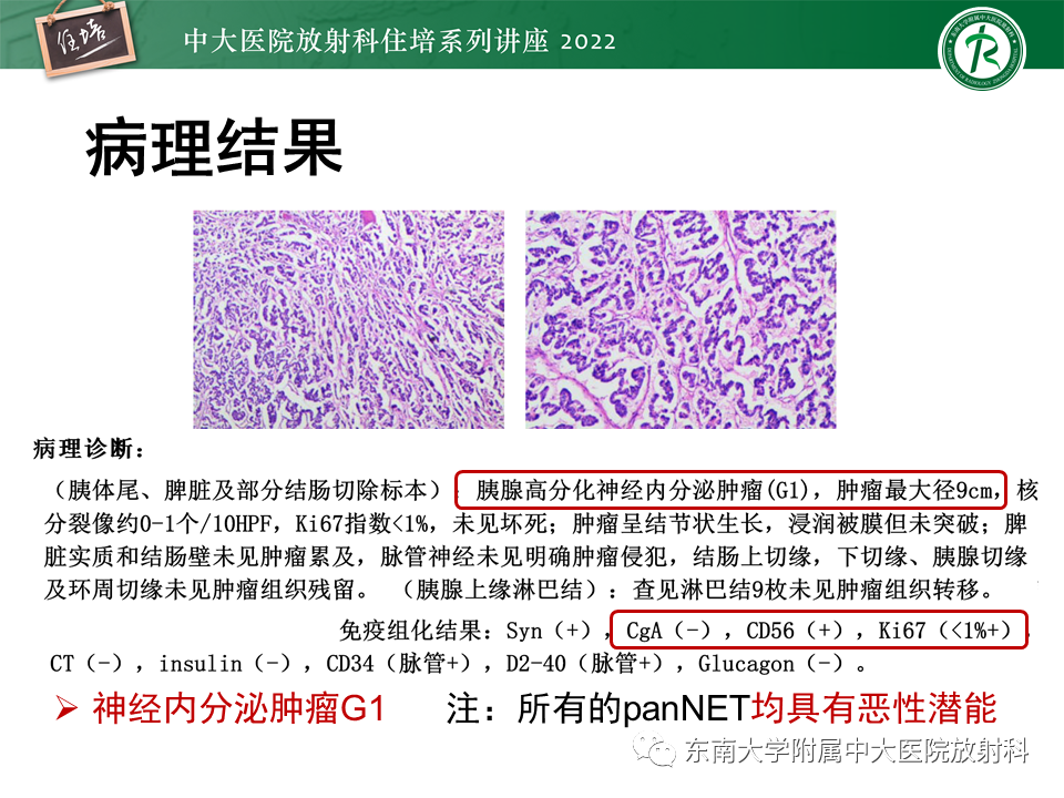 影像PPT - 【PPT】胰腺神经内分泌肿瘤的影像诊断及鉴别-25