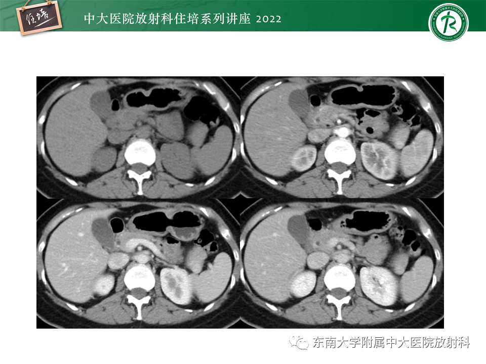 影像PPT - 【PPT】胰腺神经内分泌肿瘤的影像诊断及鉴别-41