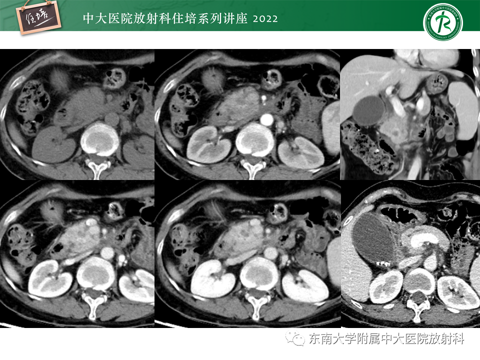 影像PPT - 【PPT】胰腺神经内分泌肿瘤的影像诊断及鉴别-28
