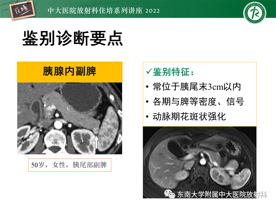 影像PPT - 【PPT】胰腺神经内分泌肿瘤的影像诊断及鉴别-45