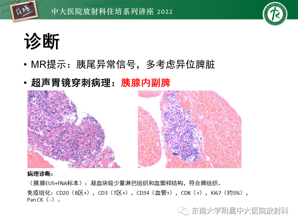 影像PPT - 【PPT】胰腺神经内分泌肿瘤的影像诊断及鉴别-43
