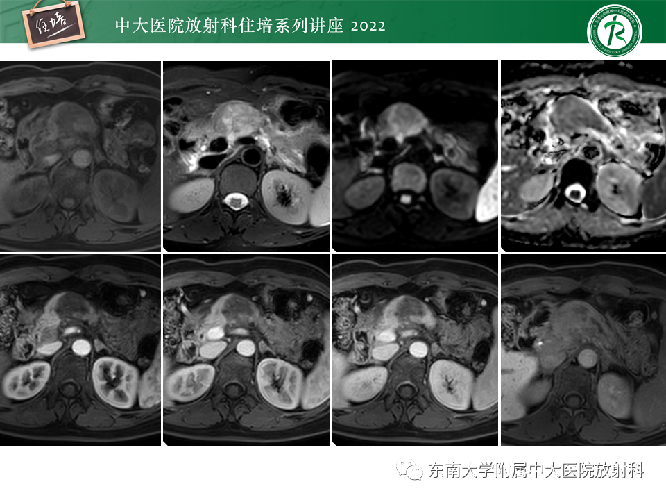 影像PPT - 【PPT】胰腺神经内分泌肿瘤的影像诊断及鉴别-48
