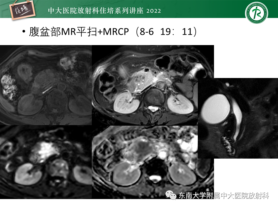 影像PPT - 【PPT】胰腺神经内分泌肿瘤的影像诊断及鉴别-29