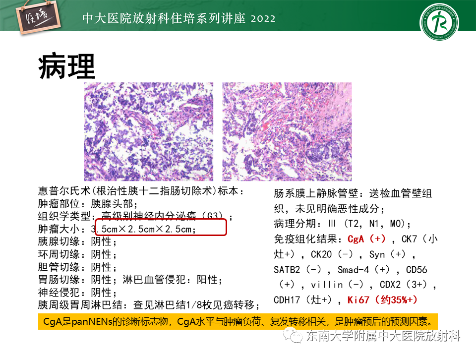 影像PPT - 【PPT】胰腺神经内分泌肿瘤的影像诊断及鉴别-32