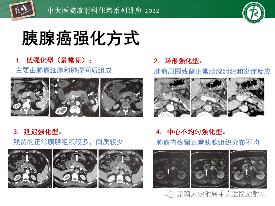 影像PPT - 【PPT】胰腺神经内分泌肿瘤的影像诊断及鉴别-57