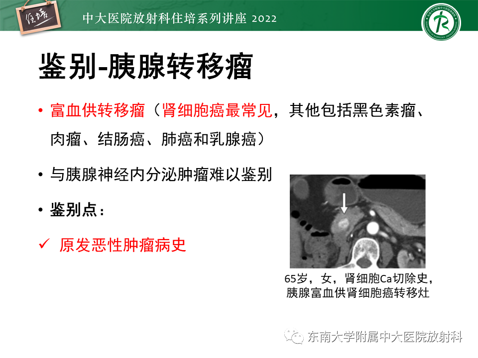 影像PPT - 【PPT】胰腺神经内分泌肿瘤的影像诊断及鉴别-60