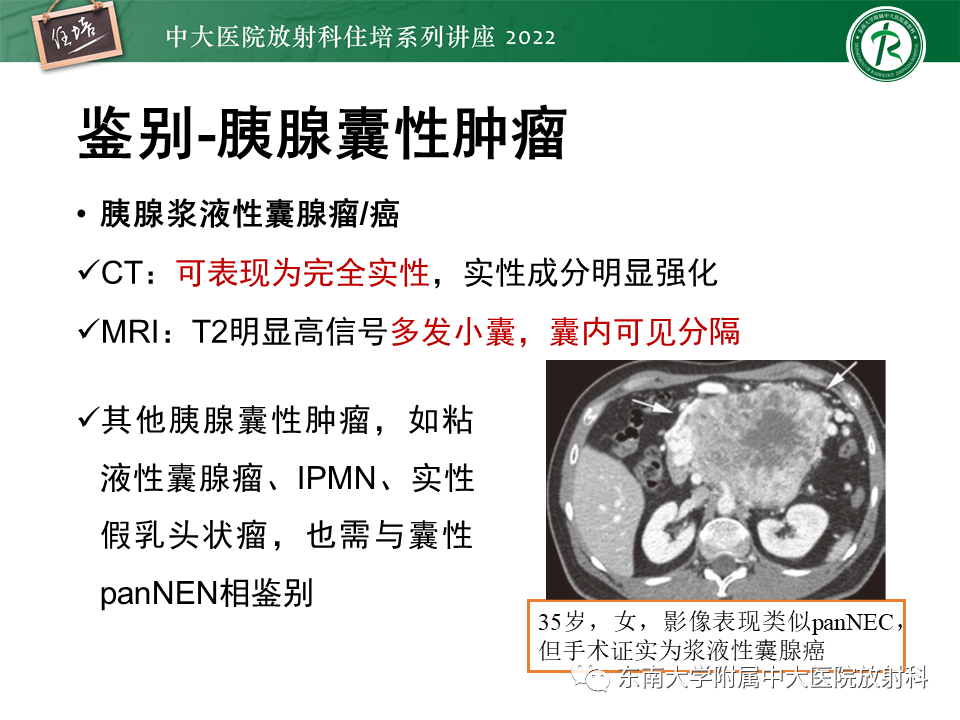 影像PPT - 【PPT】胰腺神经内分泌肿瘤的影像诊断及鉴别-65