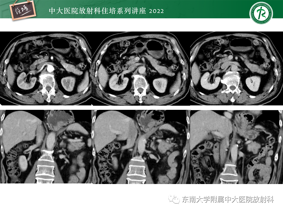 影像PPT - 【PPT】胰腺神经内分泌肿瘤的影像诊断及鉴别-62