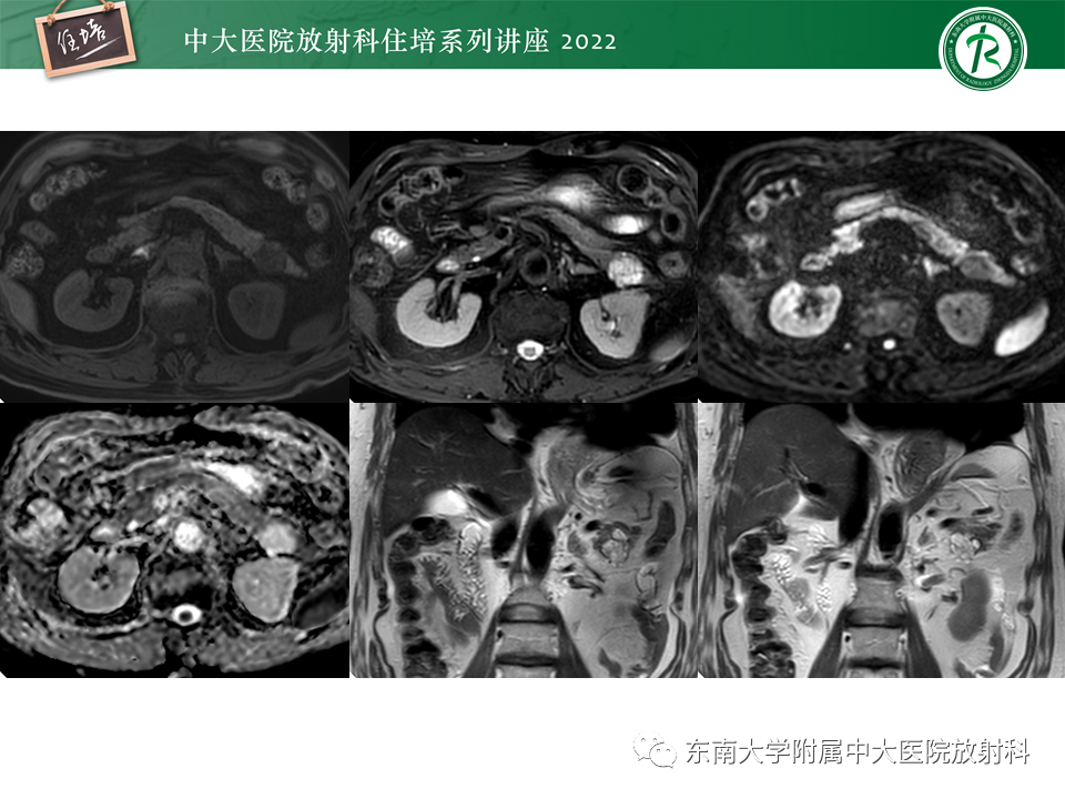 影像PPT - 【PPT】胰腺神经内分泌肿瘤的影像诊断及鉴别-63