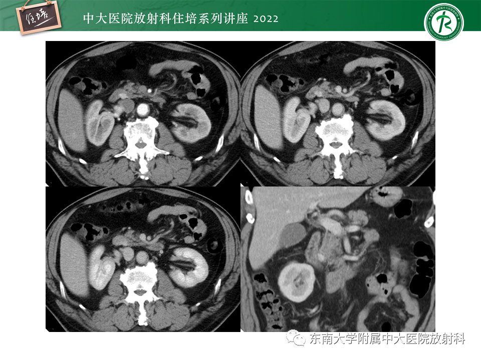 影像PPT - 【PPT】胰腺神经内分泌肿瘤的影像诊断及鉴别-67