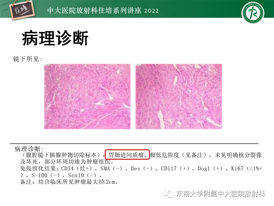 影像PPT - 【PPT】胰腺神经内分泌肿瘤的影像诊断及鉴别-69