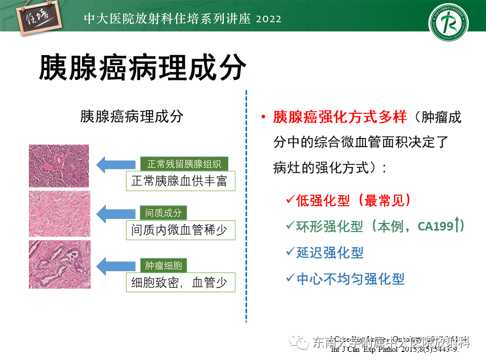 影像PPT - 【PPT】胰腺神经内分泌肿瘤的影像诊断及鉴别-56