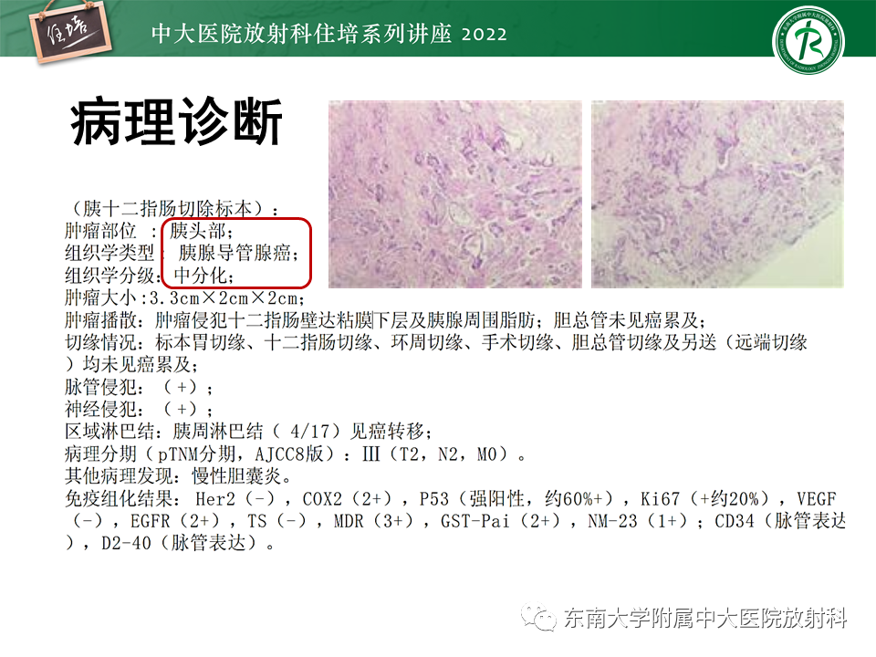 影像PPT - 【PPT】胰腺神经内分泌肿瘤的影像诊断及鉴别-55