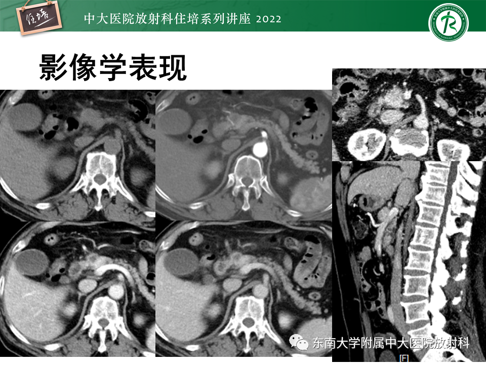 影像PPT - 【PPT】胰腺神经内分泌肿瘤的影像诊断及鉴别-54