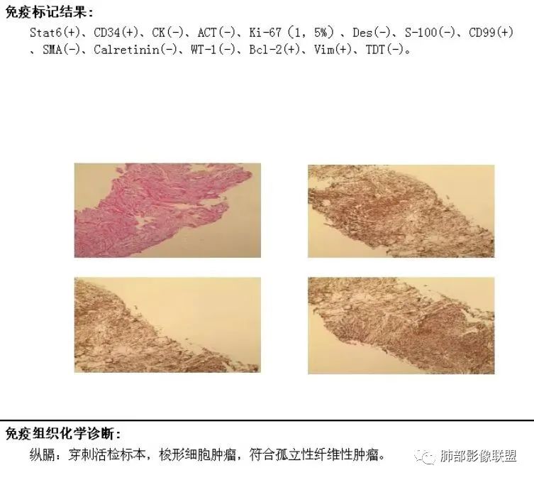 影像PPT - 【病例】纵隔肿块内错综复杂蛇纹影—孤立性纤维瘤1例CT影像-2 影像PPT - 【病例】纵隔肿块内错综复杂蛇纹影—孤立性纤维瘤1例CT影像-2