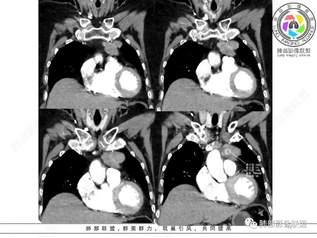 影像PPT - 【病例】胸腺瘤1例CT影像-12 影像PPT - 【病例】胸腺瘤1例CT影像-12