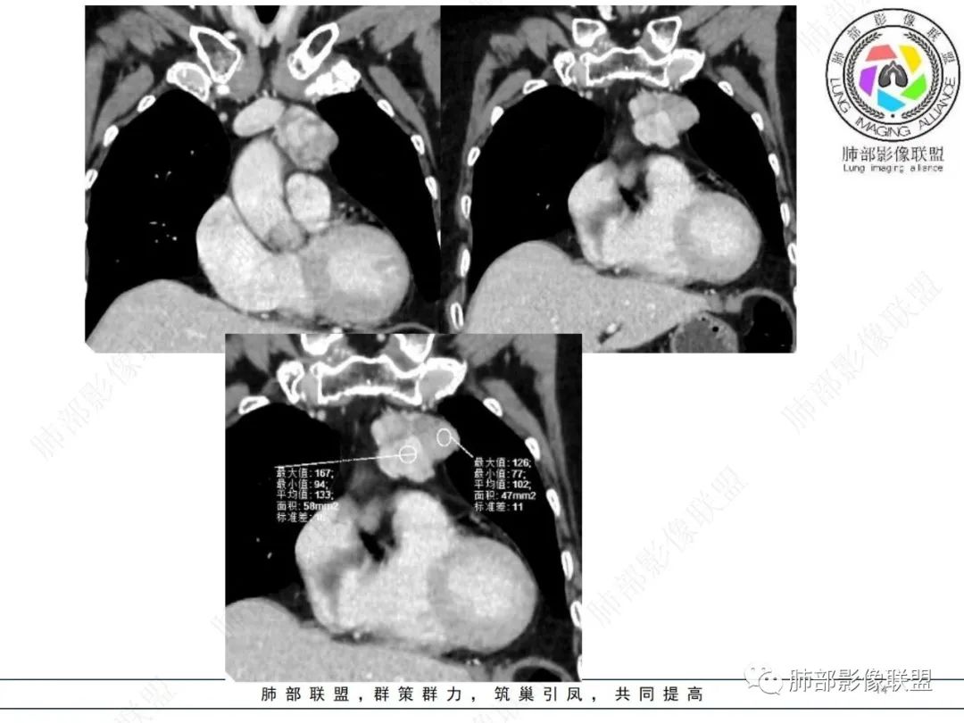 影像PPT - 【病例】胸腺瘤1例CT影像-14 影像PPT - 【病例】胸腺瘤1例CT影像-14
