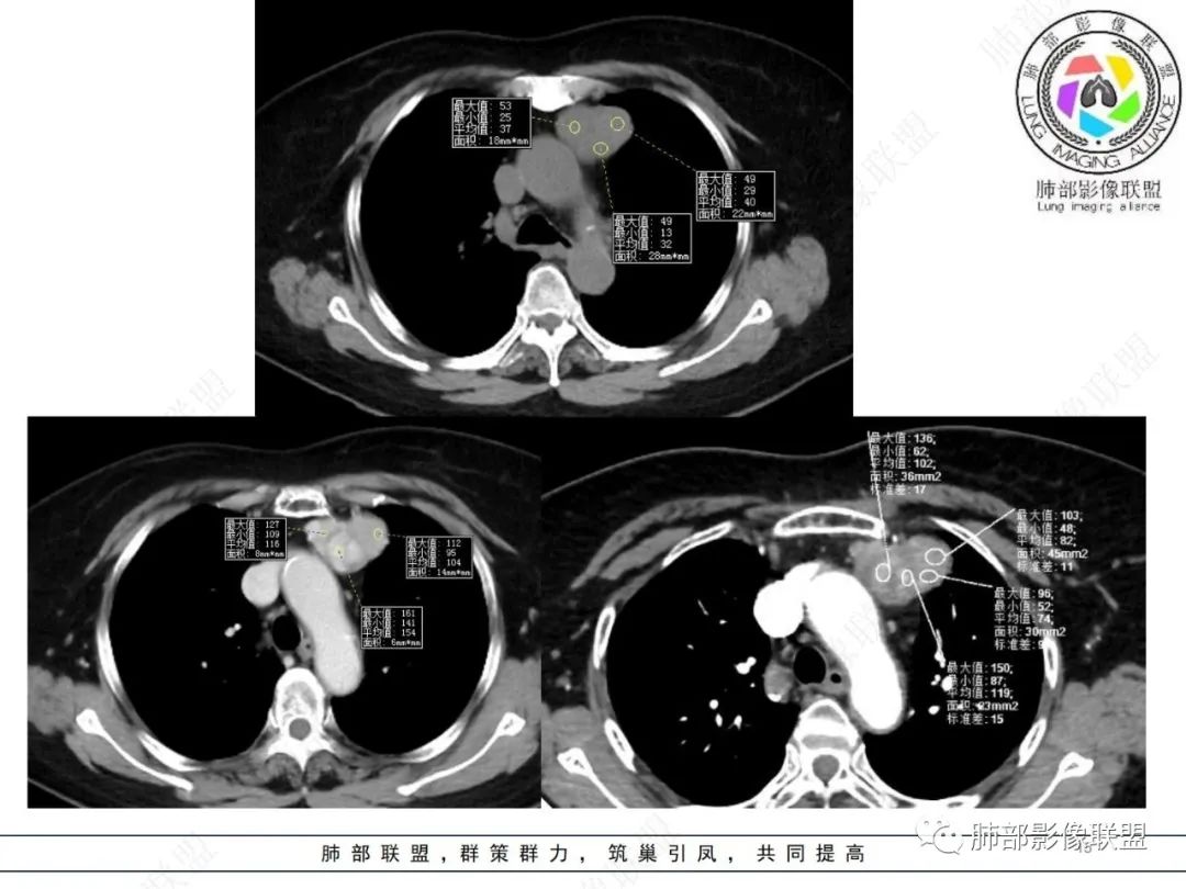 影像PPT - 【病例】胸腺瘤1例CT影像-15 影像PPT - 【病例】胸腺瘤1例CT影像-15