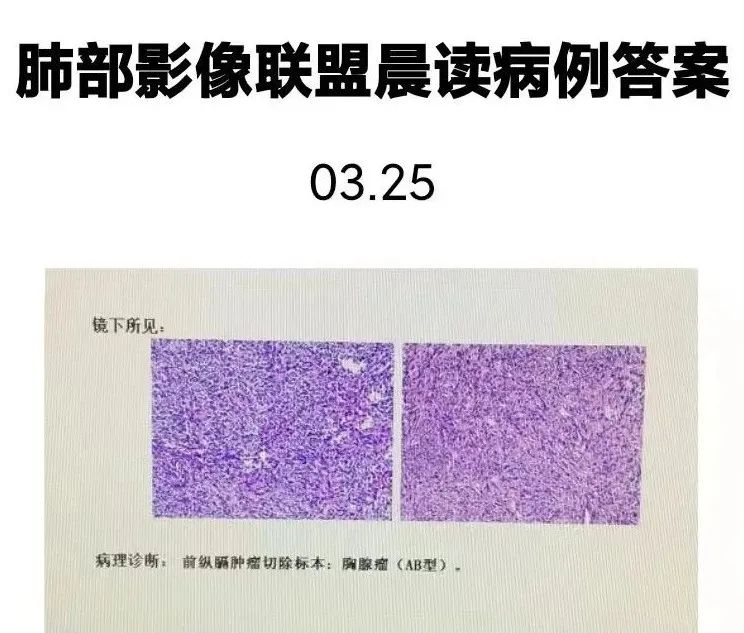 影像PPT - 【病例】胸腺瘤1例CT影像-20 影像PPT - 【病例】胸腺瘤1例CT影像-20