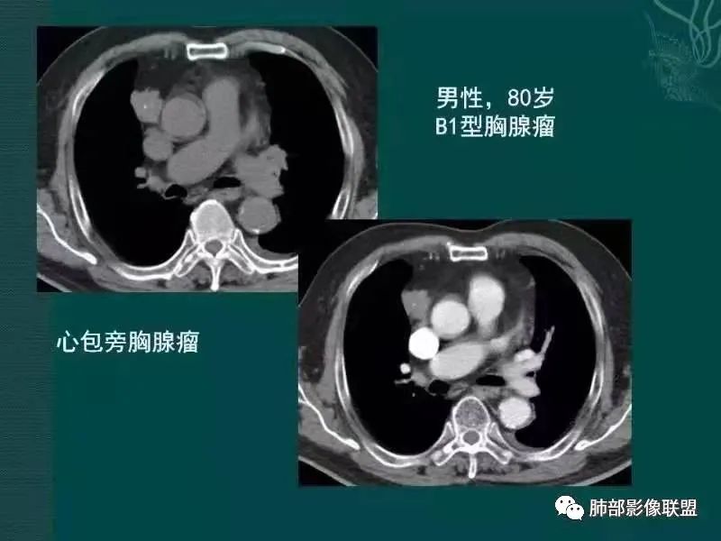 影像PPT - 【病例】胸腺瘤1例CT影像-25 影像PPT - 【病例】胸腺瘤1例CT影像-25