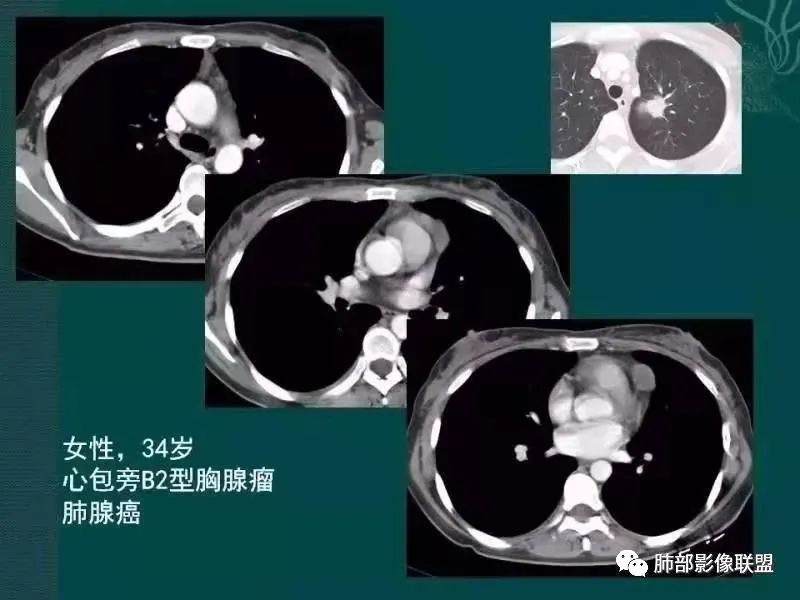 影像PPT - 【病例】胸腺瘤1例CT影像-26 影像PPT - 【病例】胸腺瘤1例CT影像-26