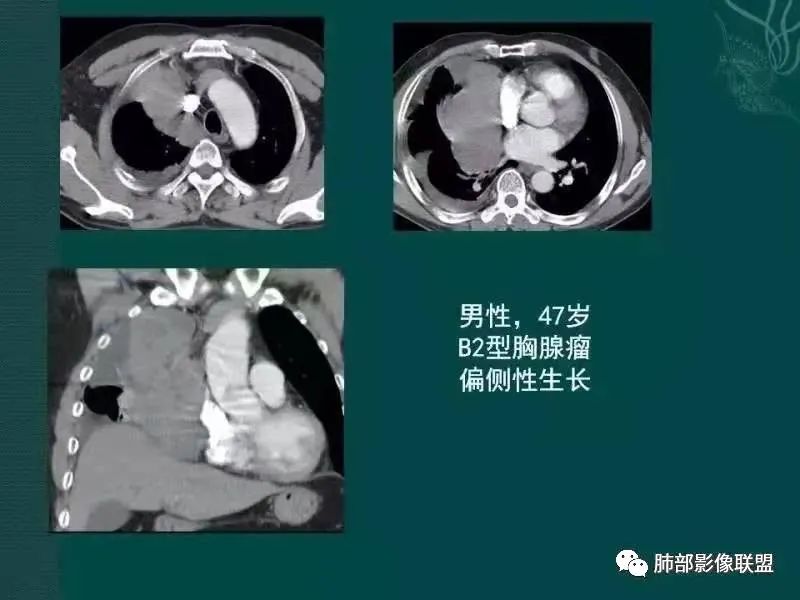 影像PPT - 【病例】胸腺瘤1例CT影像-27 影像PPT - 【病例】胸腺瘤1例CT影像-27