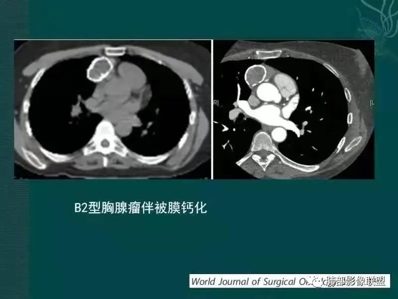 影像PPT - 【病例】胸腺瘤1例CT影像-30 影像PPT - 【病例】胸腺瘤1例CT影像-30