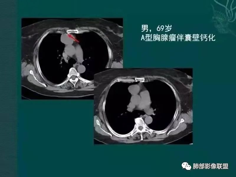 影像PPT - 【病例】胸腺瘤1例CT影像-34 影像PPT - 【病例】胸腺瘤1例CT影像-34