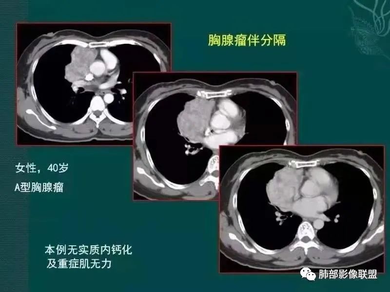 影像PPT - 【病例】胸腺瘤1例CT影像-35 影像PPT - 【病例】胸腺瘤1例CT影像-35