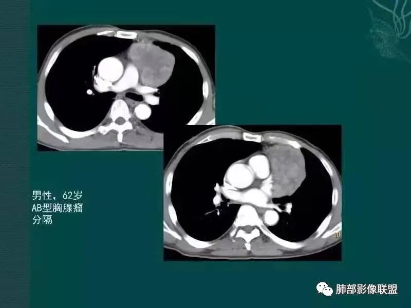 影像PPT - 【病例】胸腺瘤1例CT影像-38 影像PPT - 【病例】胸腺瘤1例CT影像-38