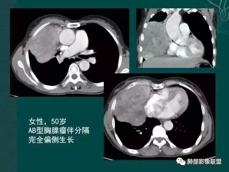 影像PPT - 【病例】胸腺瘤1例CT影像-39 影像PPT - 【病例】胸腺瘤1例CT影像-39