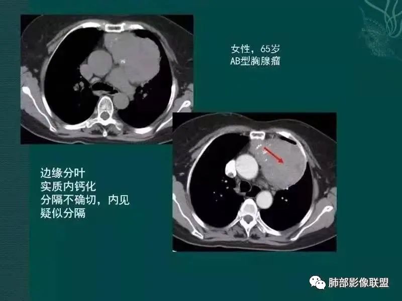 影像PPT - 【病例】胸腺瘤1例CT影像-40 影像PPT - 【病例】胸腺瘤1例CT影像-40