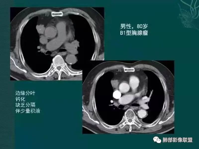 影像PPT - 【病例】胸腺瘤1例CT影像-43 影像PPT - 【病例】胸腺瘤1例CT影像-43