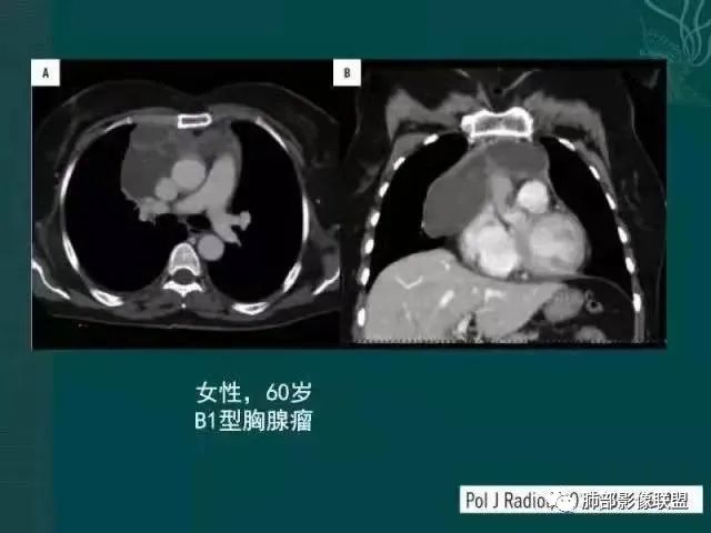 影像PPT - 【病例】胸腺瘤1例CT影像-44 影像PPT - 【病例】胸腺瘤1例CT影像-44