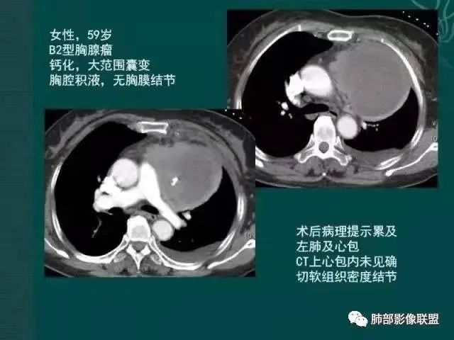 影像PPT - 【病例】胸腺瘤1例CT影像-47 影像PPT - 【病例】胸腺瘤1例CT影像-47