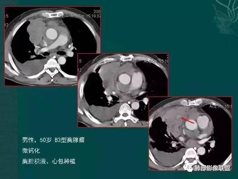 影像PPT - 【病例】胸腺瘤1例CT影像-50 影像PPT - 【病例】胸腺瘤1例CT影像-50
