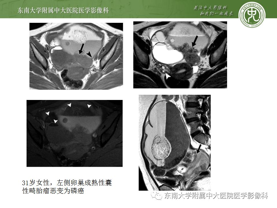 影像PPT - 【病例】卵巢成熟畸胎瘤1例CT及MR影像-17