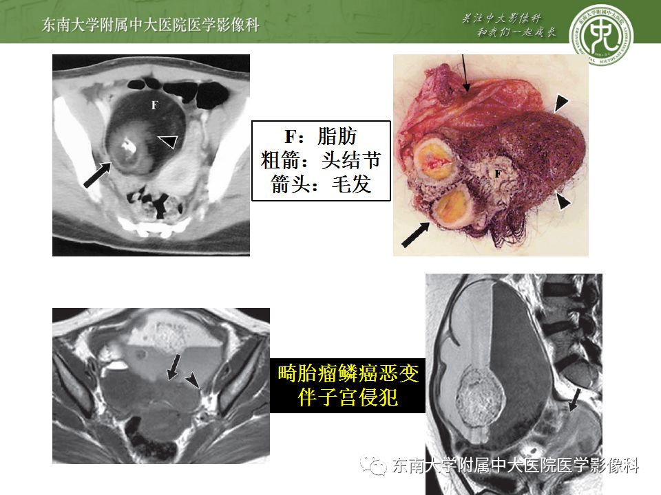 影像PPT - 【病例】卵巢成熟畸胎瘤1例CT及MR影像-18