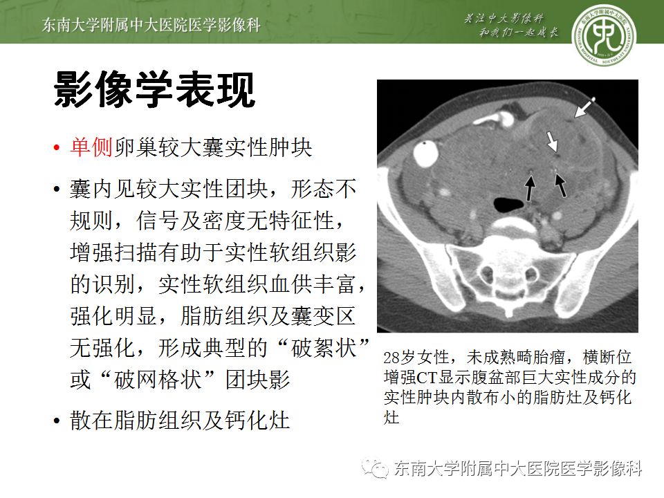 影像PPT - 【病例】卵巢成熟畸胎瘤1例CT及MR影像-20