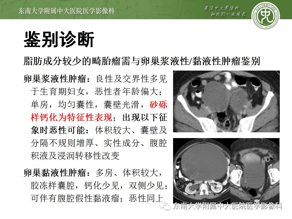 影像PPT - 【病例】卵巢成熟畸胎瘤1例CT及MR影像-23