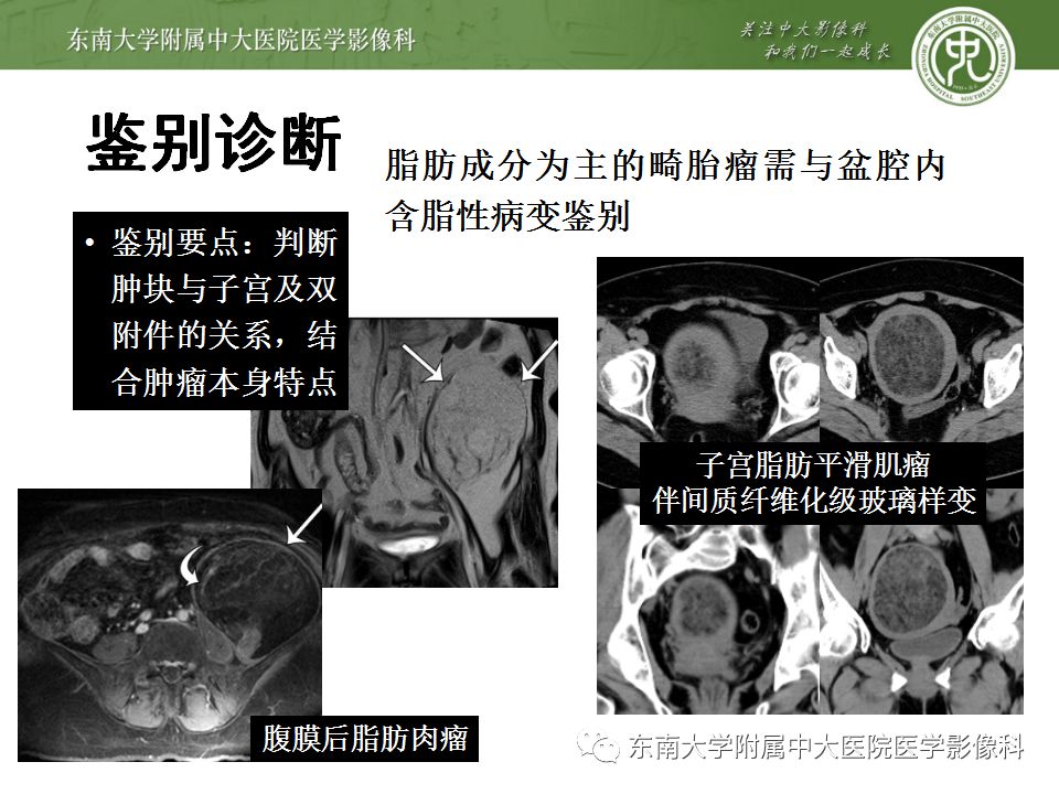 影像PPT - 【病例】卵巢成熟畸胎瘤1例CT及MR影像-24