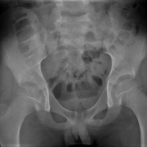 影像PPT - 【病例】非细菌性骨髓炎1例X线MR影像-3 影像PPT - 【病例】非细菌性骨髓炎1例X线MR影像-3