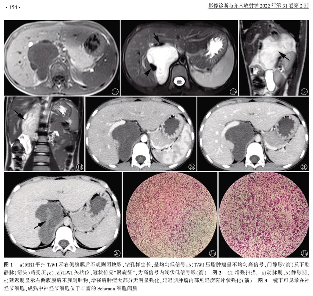 影像PPT - 【病例】原发性腹膜后肿物—节细胞神经瘤1例影像诊断思维-4