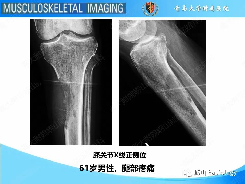 影像PPT - 【PPT】溶骨性骨质破坏-2
