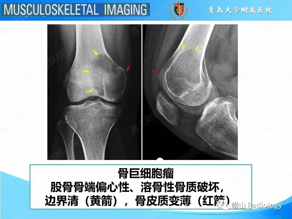 影像PPT - 【PPT】溶骨性骨质破坏-5