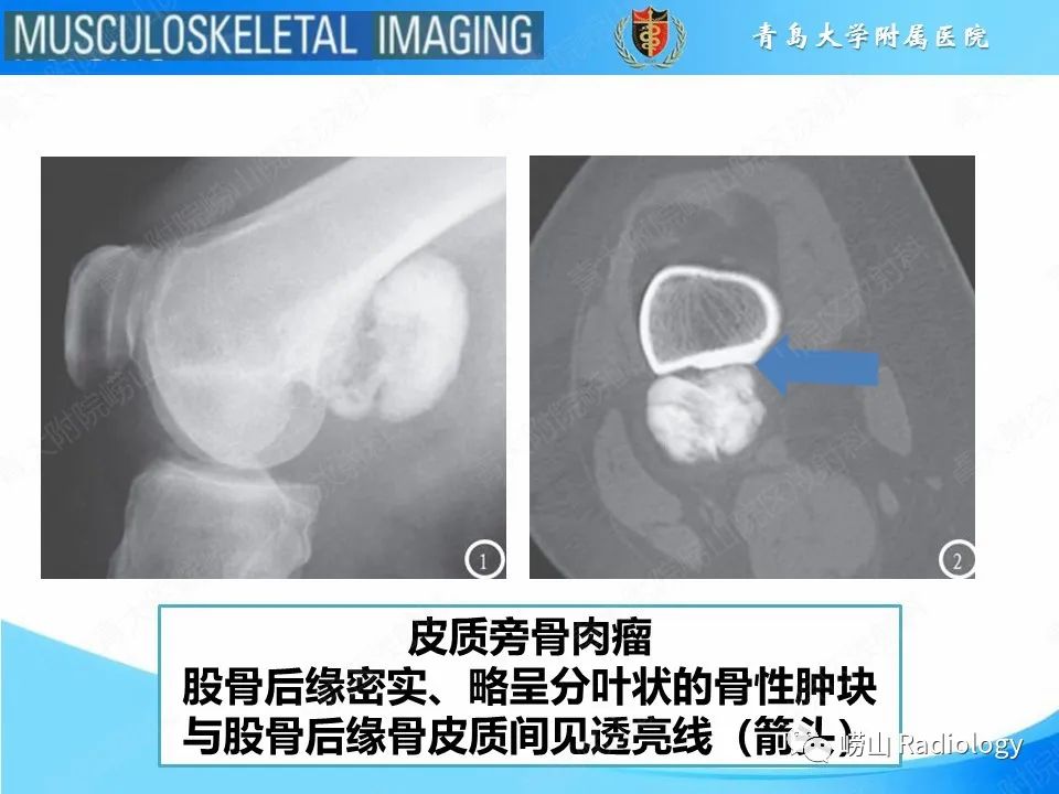 影像PPT - 【PPT】溶骨性骨质破坏-10