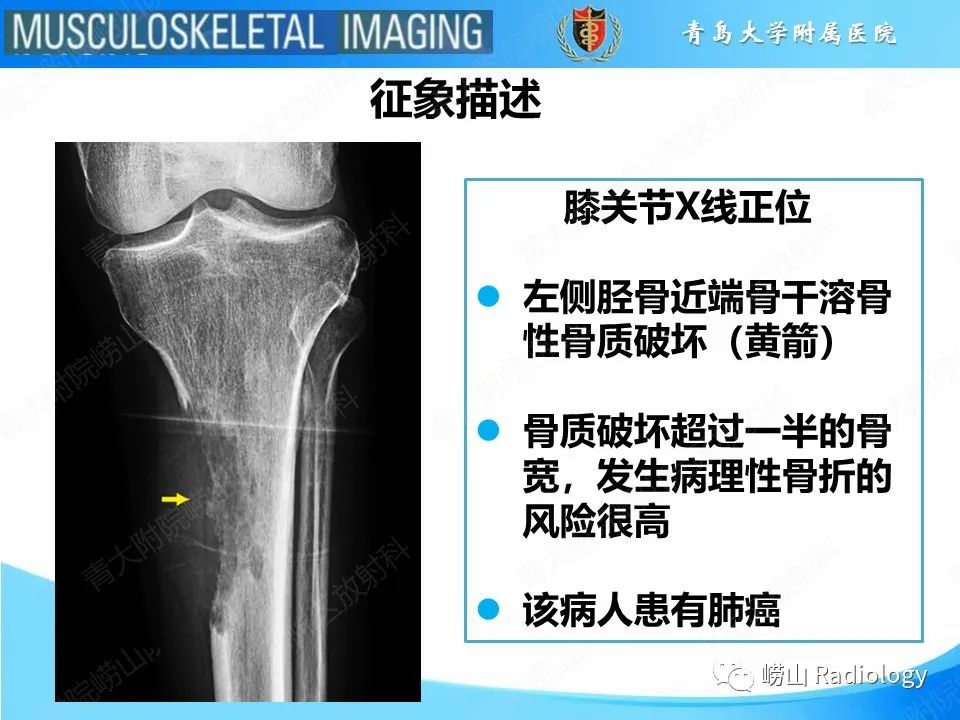 影像PPT - 【PPT】溶骨性骨质破坏-13