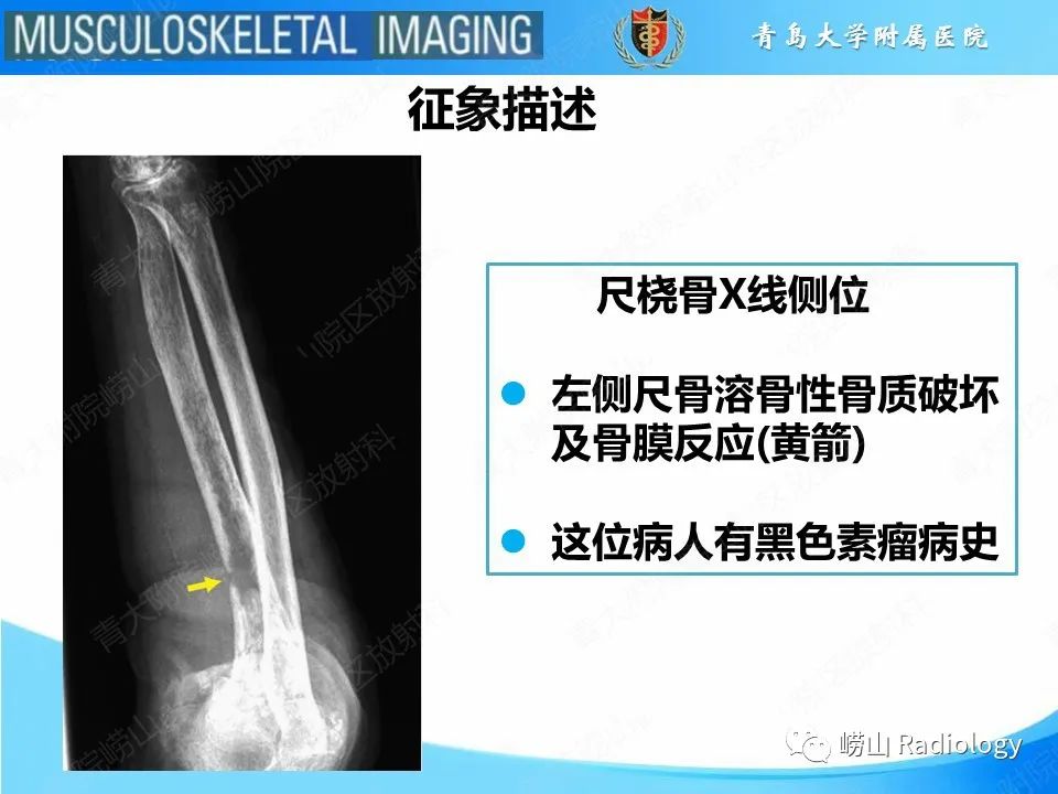 影像PPT - 【PPT】溶骨性骨质破坏-15