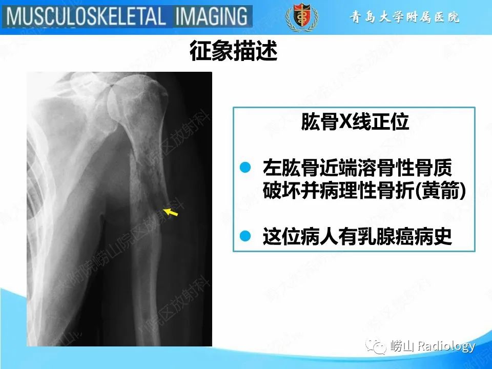 影像PPT - 【PPT】溶骨性骨质破坏-16