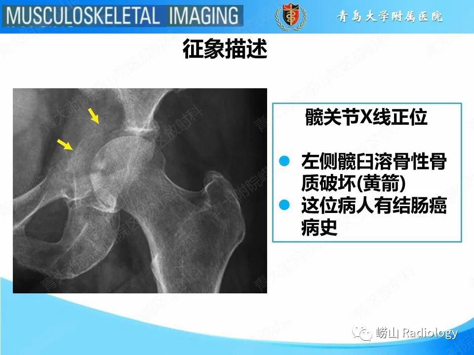 影像PPT - 【PPT】溶骨性骨质破坏-17